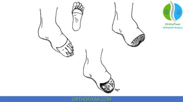 Essential Guide To Transmetatarsal Amputation: Recovery And Rehabilitation