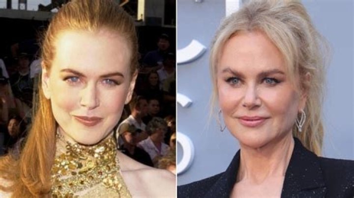 Unveiling The Truth Behind Nicole Kidman's Plastic Surgery Journey